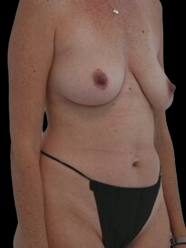 DIEP Flap Implant Hybrid Based Reconstruction Before & After Image