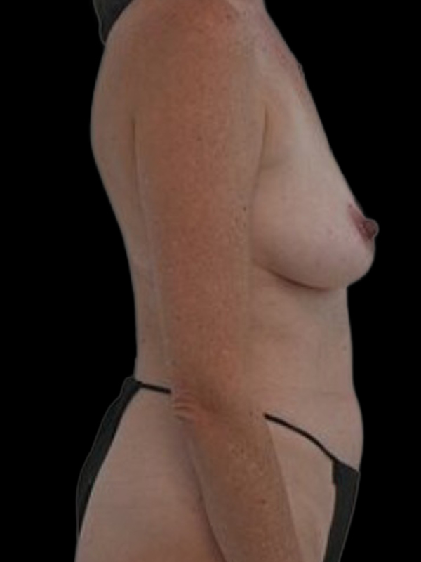 DIEP Flap Implant Hybrid Based Reconstruction Before & After Image
