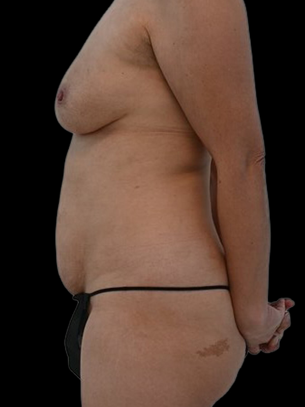 DIEP Flap Implant Hybrid Based Reconstruction Before & After Image