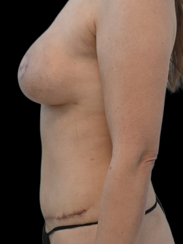 DIEP Flap Implant Hybrid Based Reconstruction Before & After Image