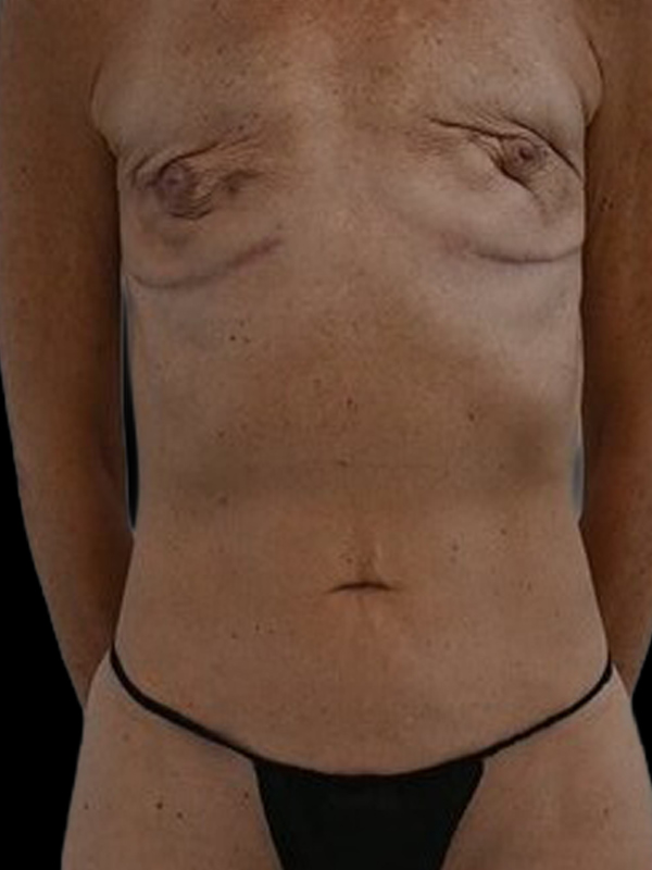 DIEP Flap Implant Hybrid Based Reconstruction Before & After Image
