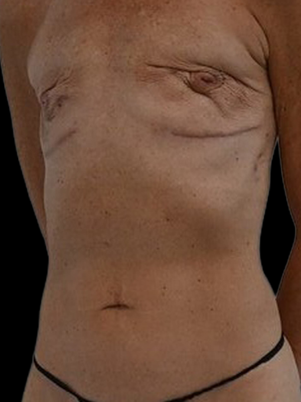 DIEP Flap Implant Hybrid Based Reconstruction Before & After Image