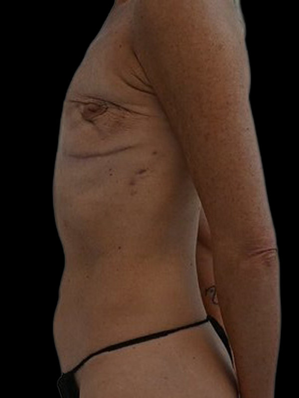 DIEP Flap Implant Hybrid Based Reconstruction Before & After Image