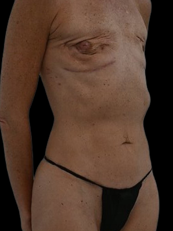 DIEP Flap Implant Hybrid Based Reconstruction Before & After Image