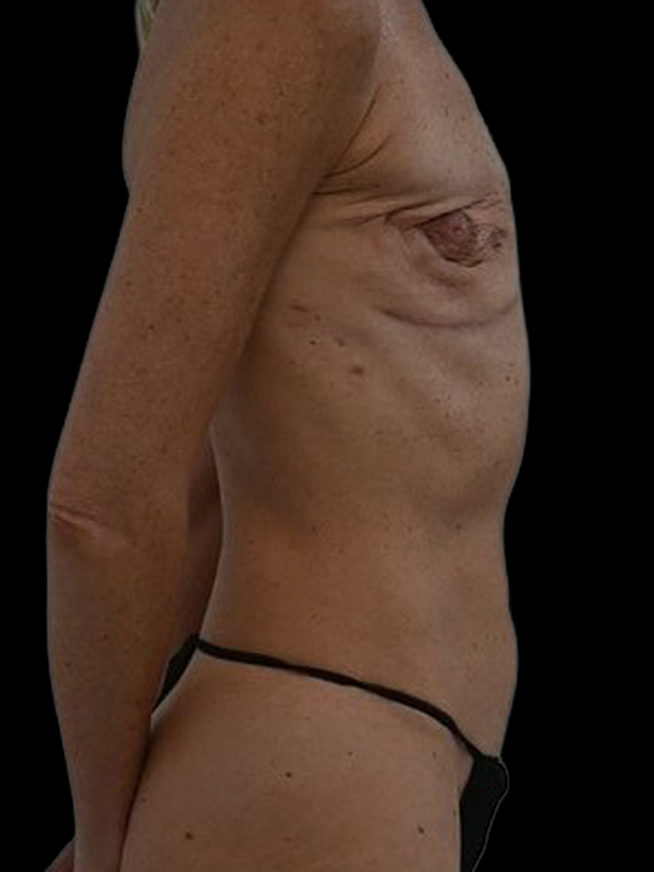 DIEP Flap Implant Hybrid Based Reconstruction Before & After Image