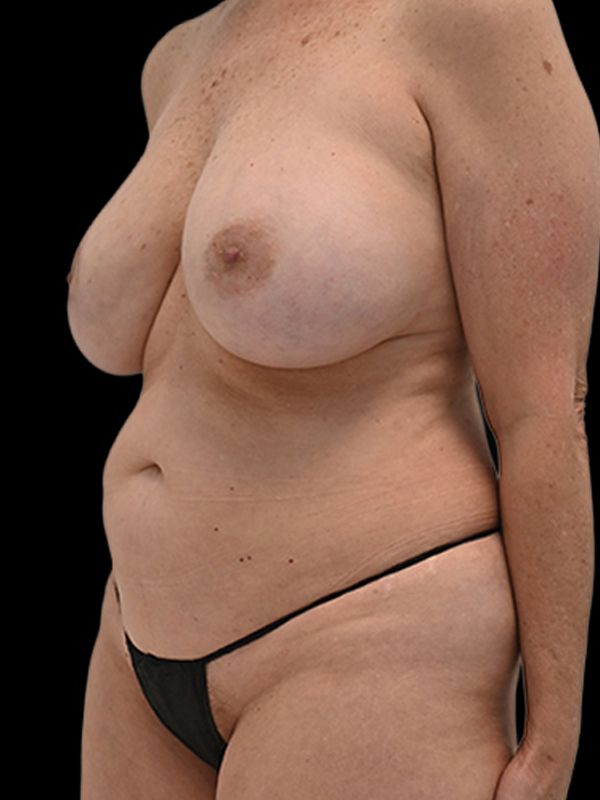 DIEP Flap Implant Hybrid Based Reconstruction Before & After Image