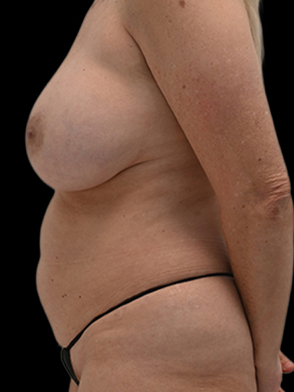 DIEP Flap Implant Hybrid Based Reconstruction Before & After Image