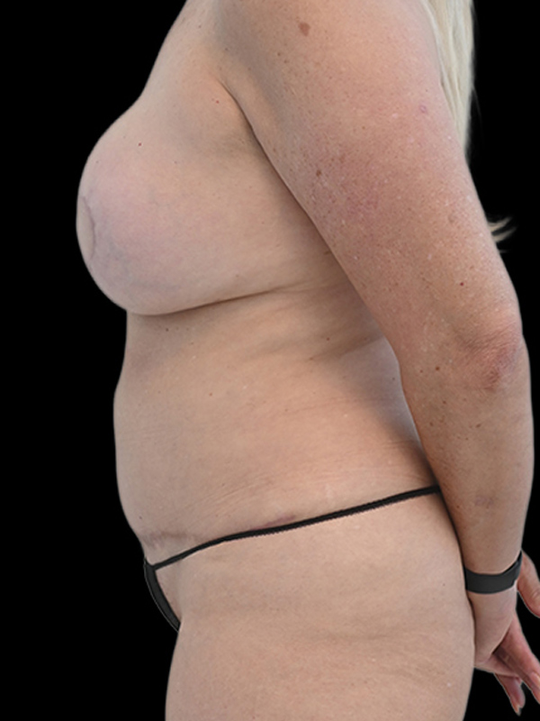 DIEP Flap Implant Hybrid Based Reconstruction Before & After Image