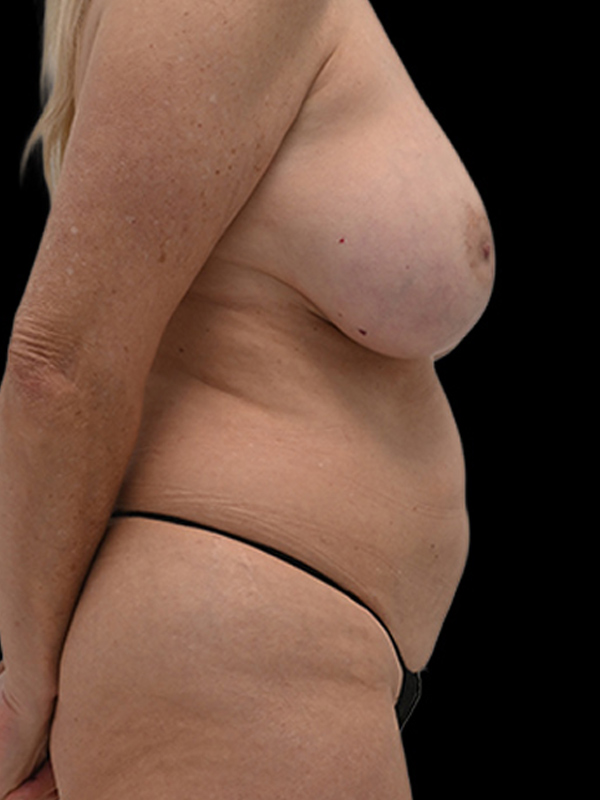 DIEP Flap Implant Hybrid Based Reconstruction Before & After Image