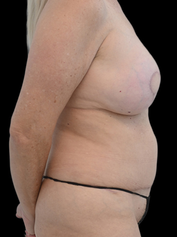 DIEP Flap Implant Hybrid Based Reconstruction Before & After Image
