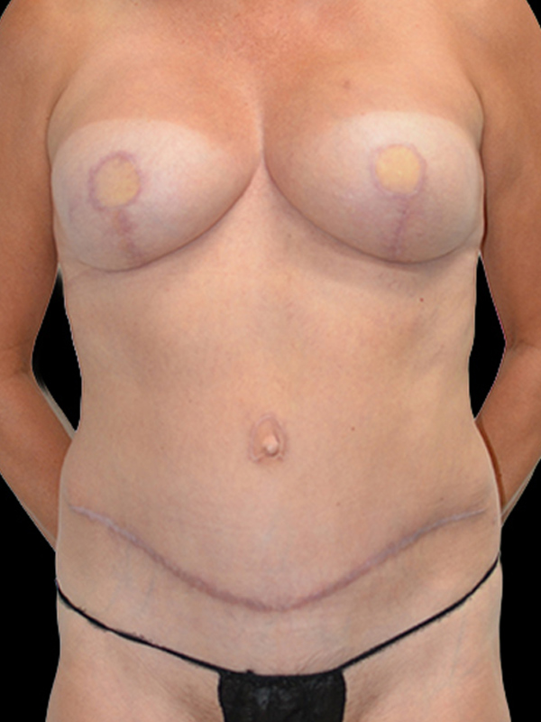 DIEP Flap Implant Hybrid Based Reconstruction Before & After Image