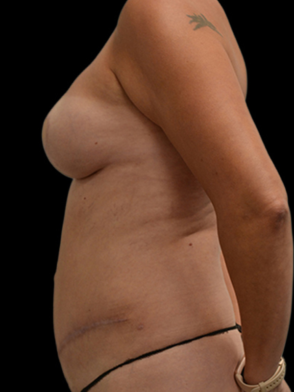 DIEP Flap Implant Hybrid Based Reconstruction Before & After Image