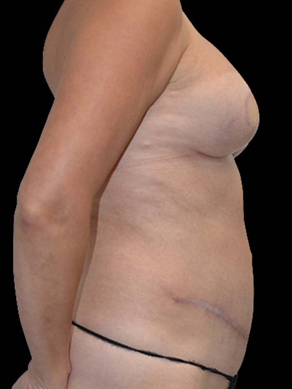 DIEP Flap Implant Hybrid Based Reconstruction Before & After Image