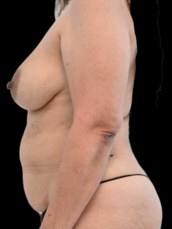 DIEP Flap Implant Hybrid Based Reconstruction Before & After Image