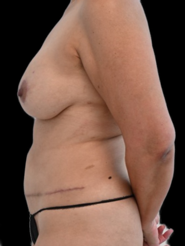 DIEP Flap Implant Hybrid Based Reconstruction Before & After Image