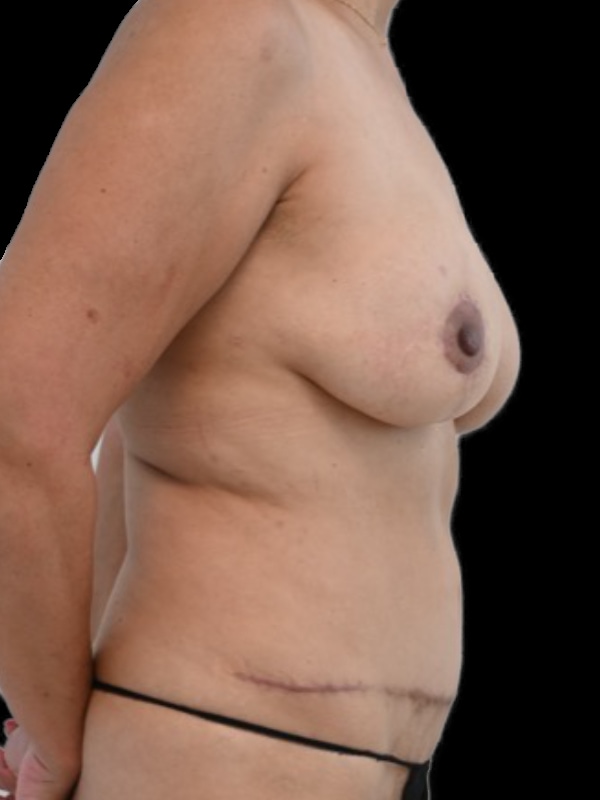 DIEP Flap Implant Hybrid Based Reconstruction Before & After Image