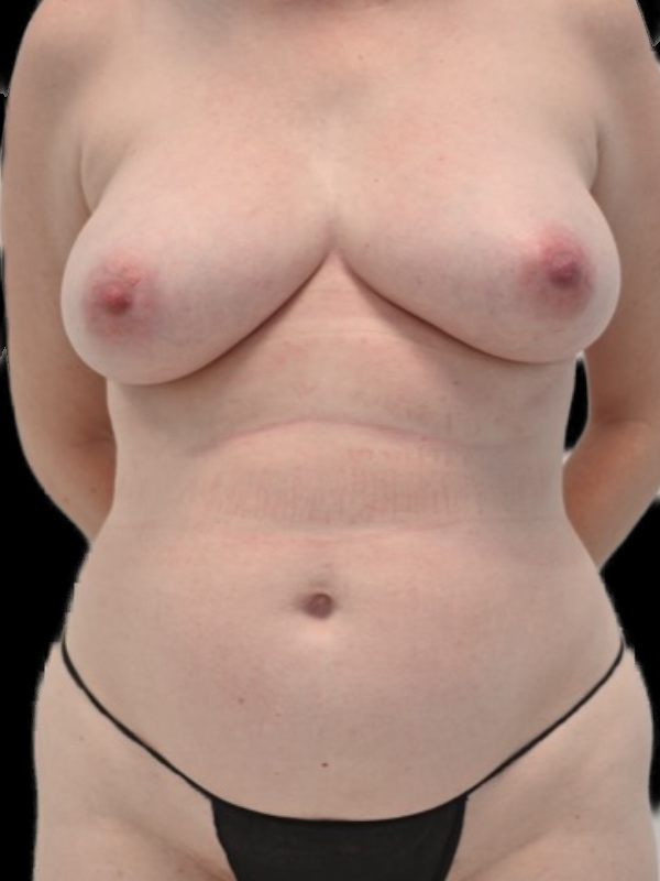 DIEP Flap Implant Hybrid Based Reconstruction Before & After Image