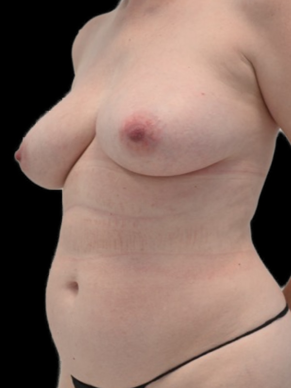 DIEP Flap Implant Hybrid Based Reconstruction Before & After Image