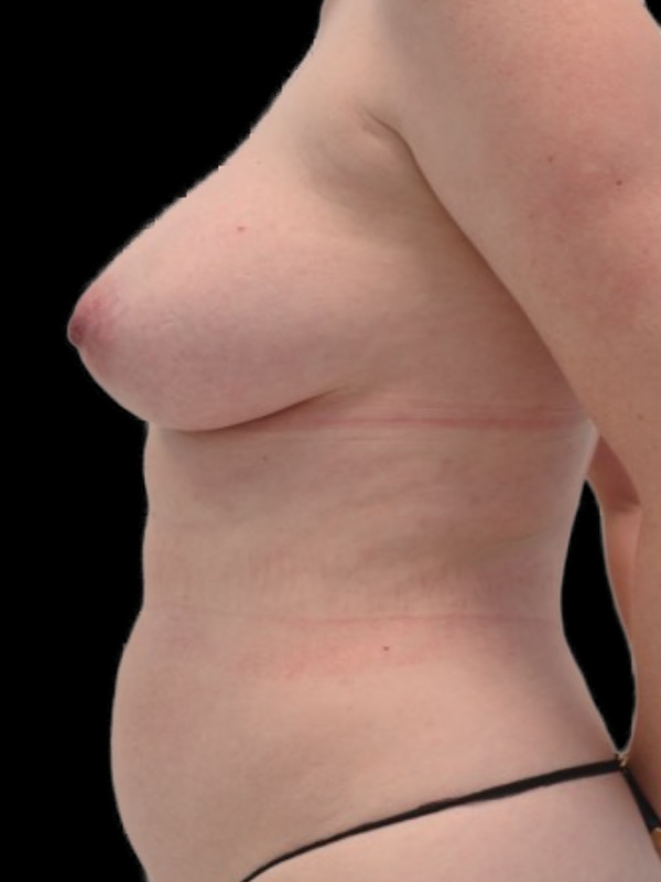 DIEP Flap Implant Hybrid Based Reconstruction Before & After Image