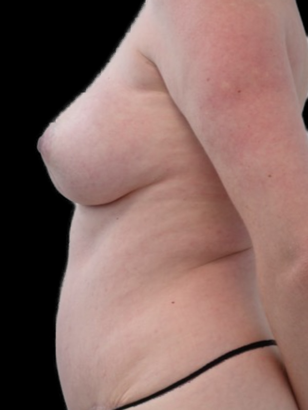 DIEP Flap Implant Hybrid Based Reconstruction Before & After Image