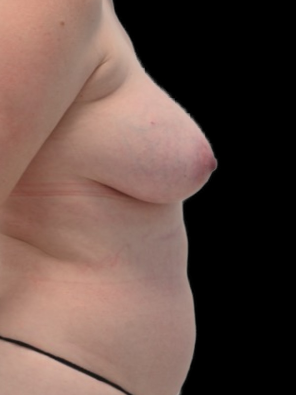DIEP Flap Implant Hybrid Based Reconstruction Before & After Image