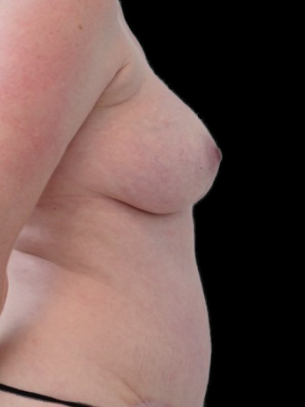 DIEP Flap Implant Hybrid Based Reconstruction Before & After Image