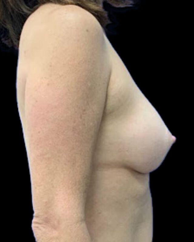 DIEP Flap Surgery Before & After Image