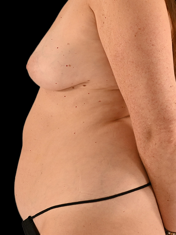 DIEP Flap Surgery Before & After Image