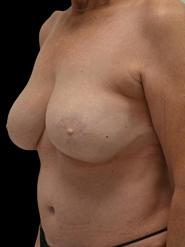 DIEP Flap Surgery Before & After Image