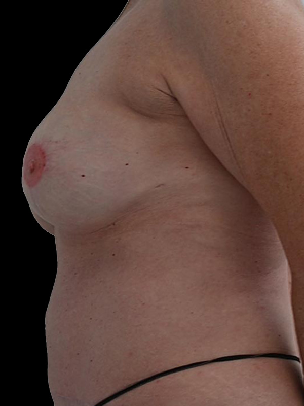 DIEP Flap Surgery Before & After Image