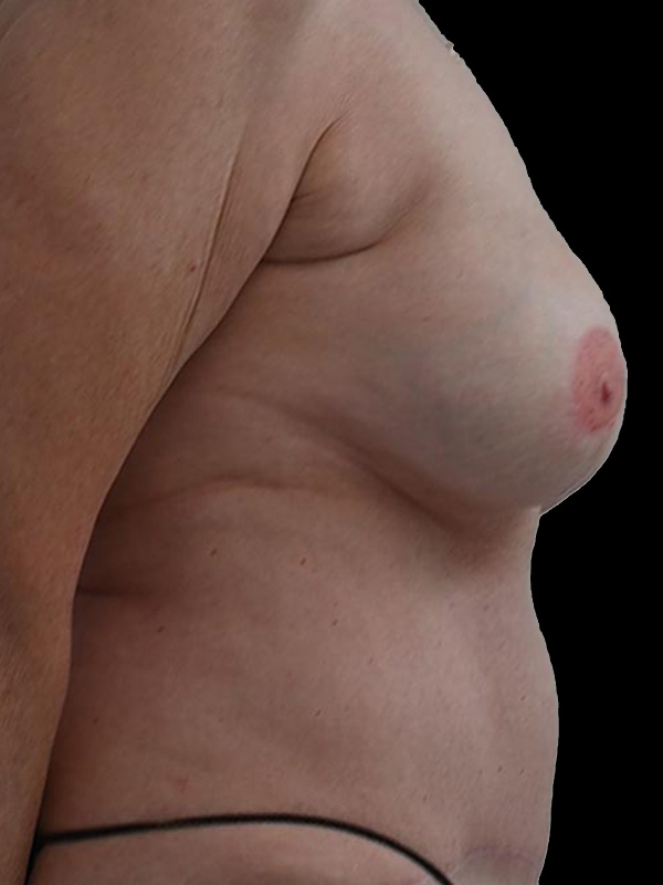 DIEP Flap Surgery Before & After Image