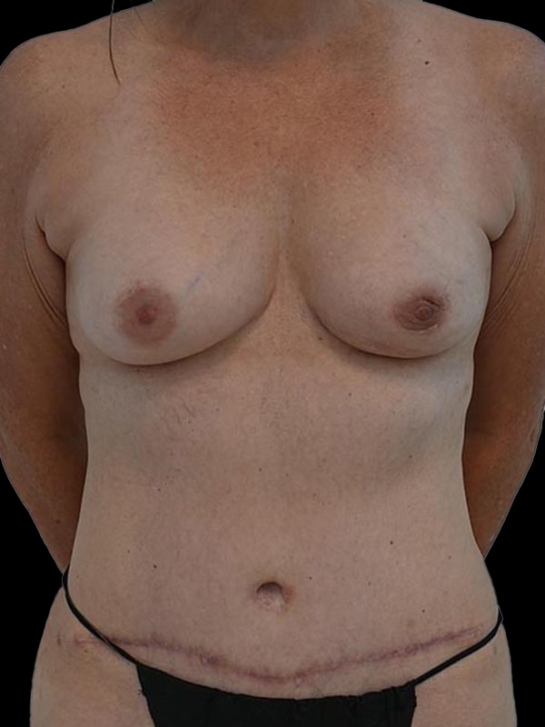 DIEP Flap Surgery Before & After Image