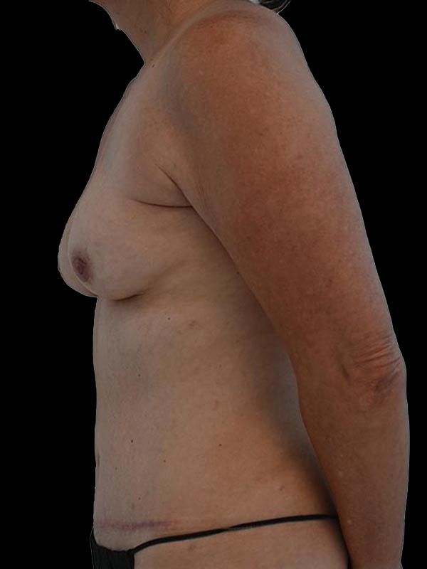 DIEP Flap Surgery Before & After Image