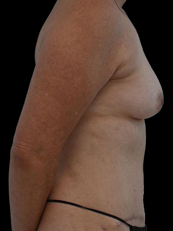 DIEP Flap Surgery Before & After Image