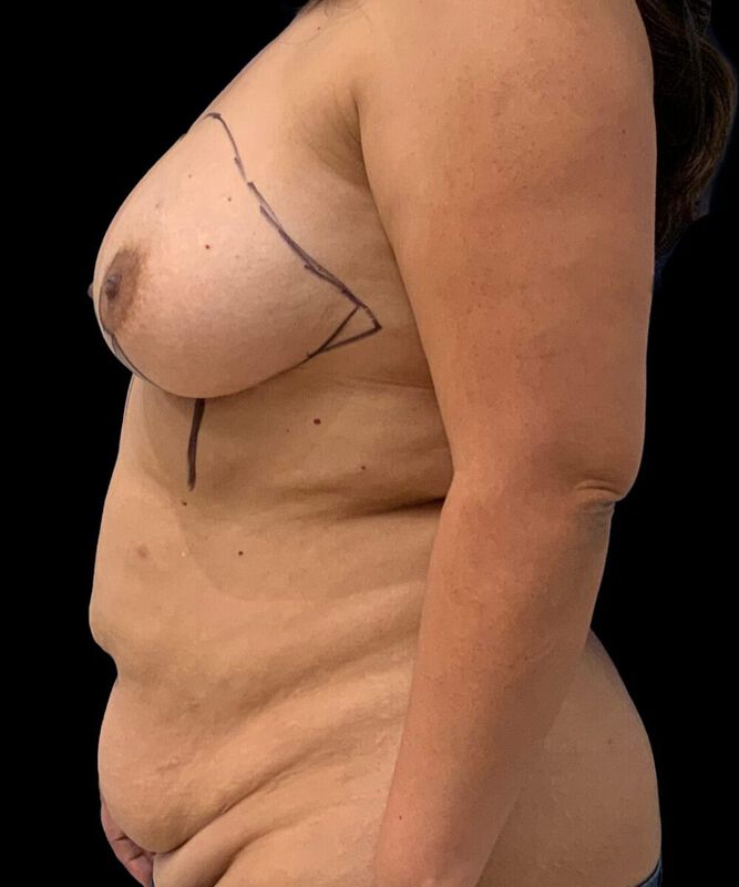 DIEP Flap Surgery Before & After Image