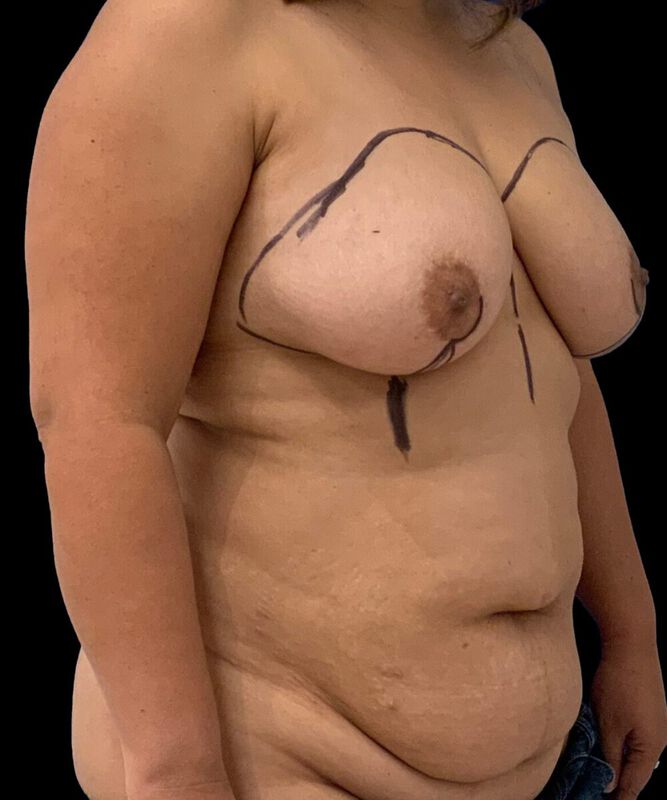 DIEP Flap Surgery Before & After Image