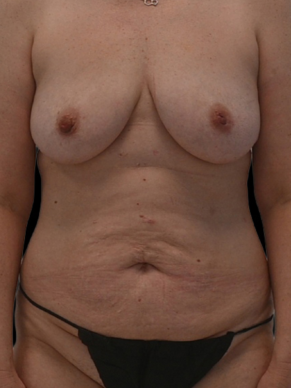 diep flap surgery Before & After Image