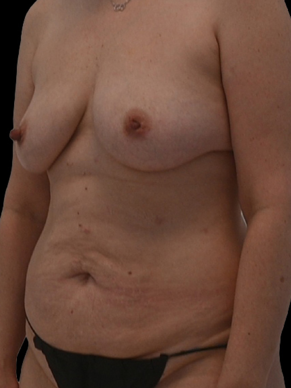 diep flap surgery Before & After Image