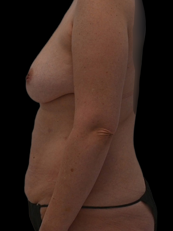 DIEP Flap Surgery Before & After Image