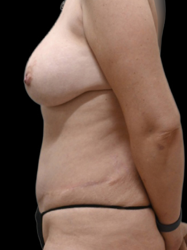 DIEP Flap Surgery Before & After Image