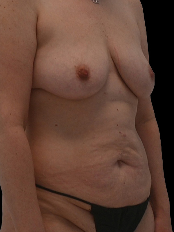 DIEP Flap Surgery Before & After Image
