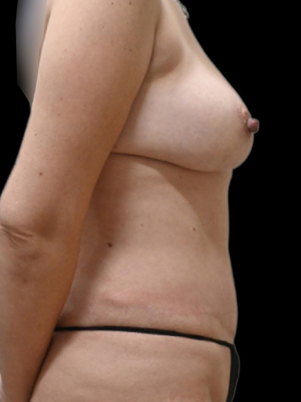 DIEP Flap Surgery Before & After Image