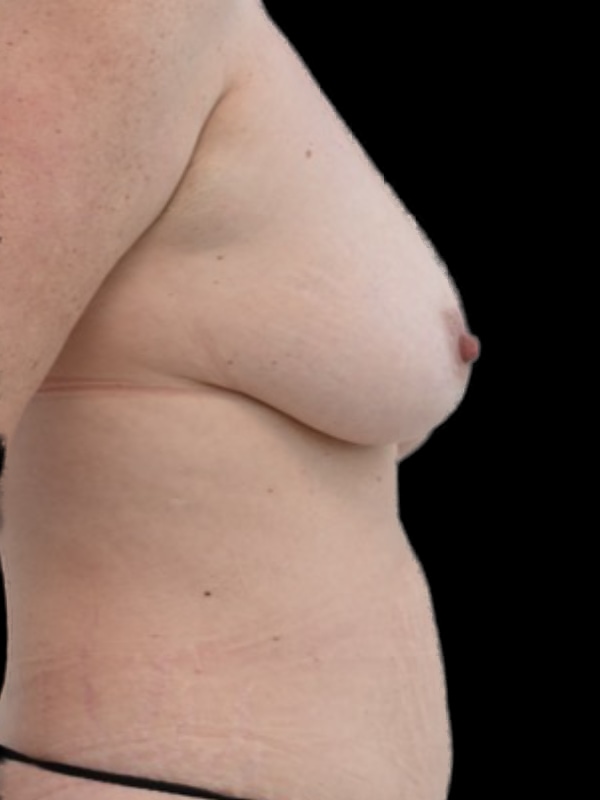 DIEP Flap Surgery Before & After Image