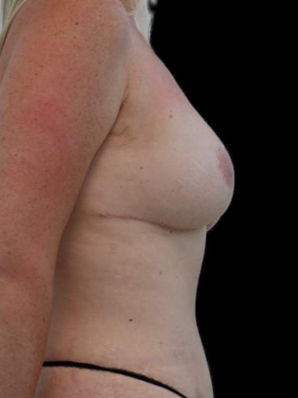 DIEP Flap Surgery Before & After Image