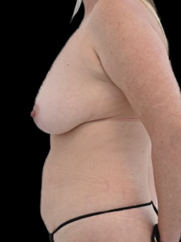DIEP Flap Surgery Before & After Image