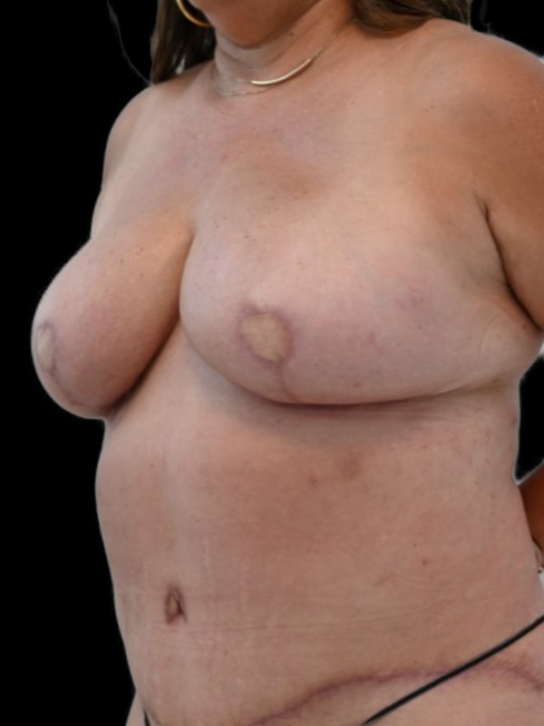 DIEP Flap Surgery Before & After Image