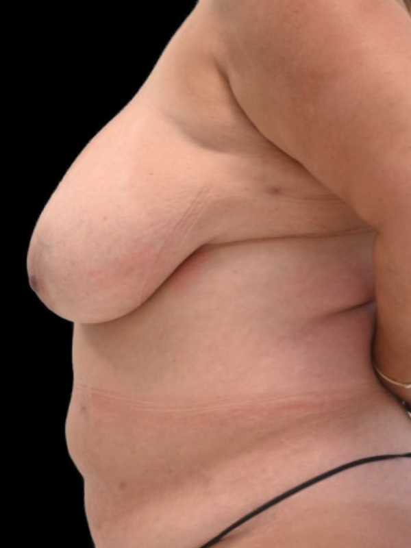 DIEP Flap Surgery Before & After Image