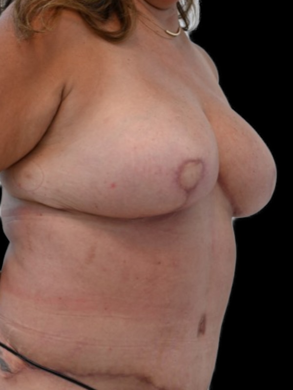 DIEP Flap Surgery Before & After Image