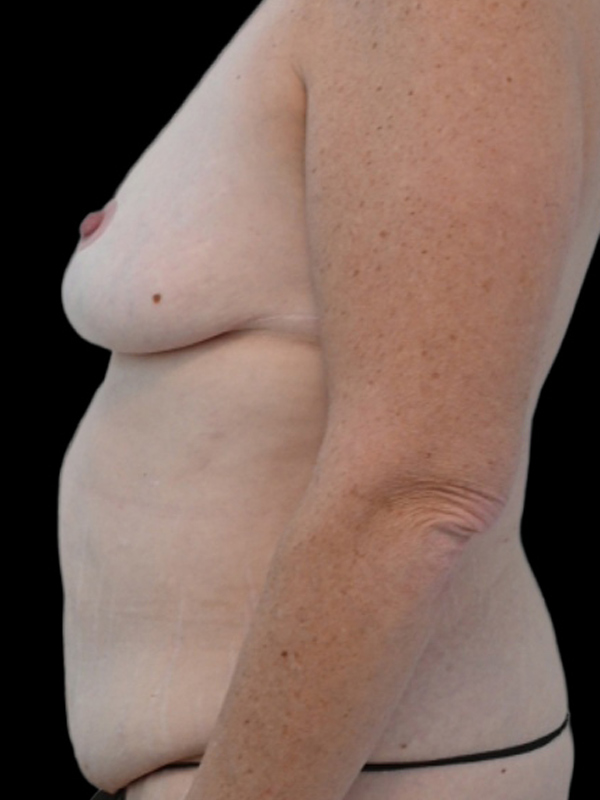 DIEP Flap Surgery Before & After Image