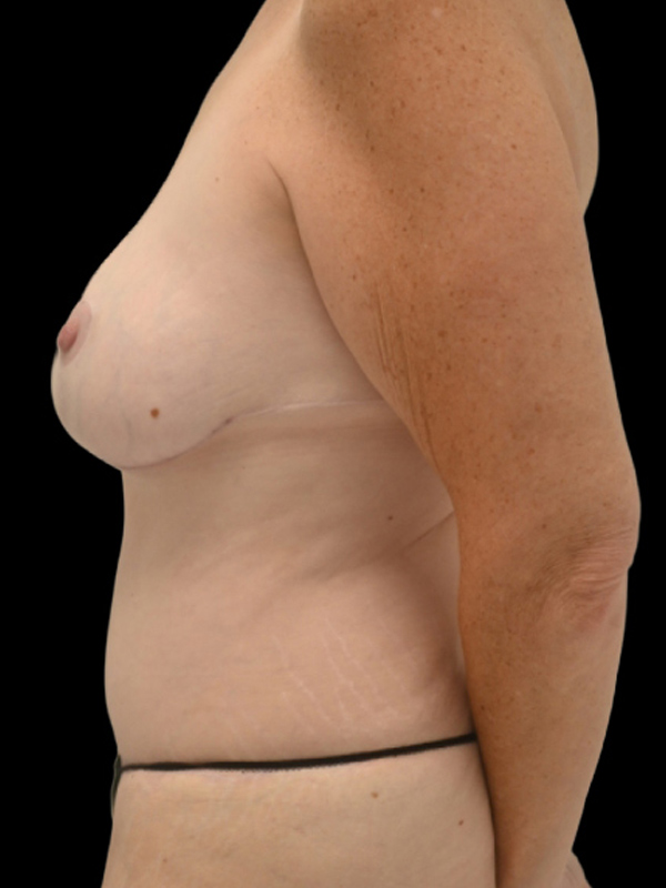 DIEP Flap Surgery Before & After Image
